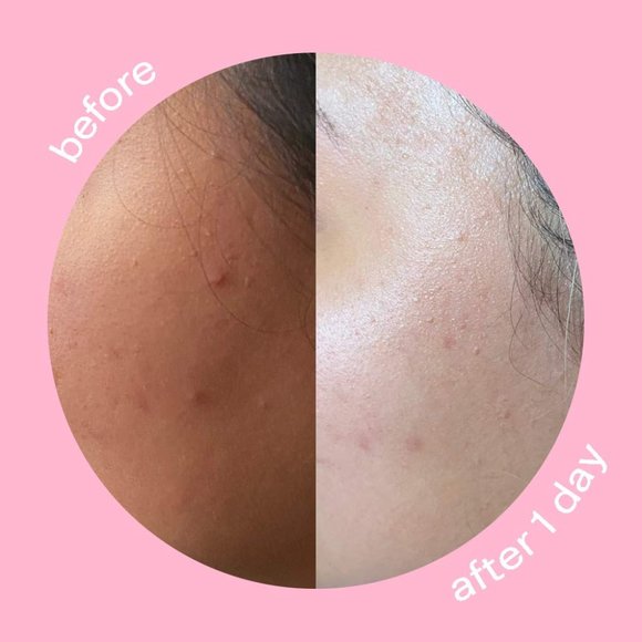 Peach Slices Hydrocolloid Acne Patches - Picture 2 of 3